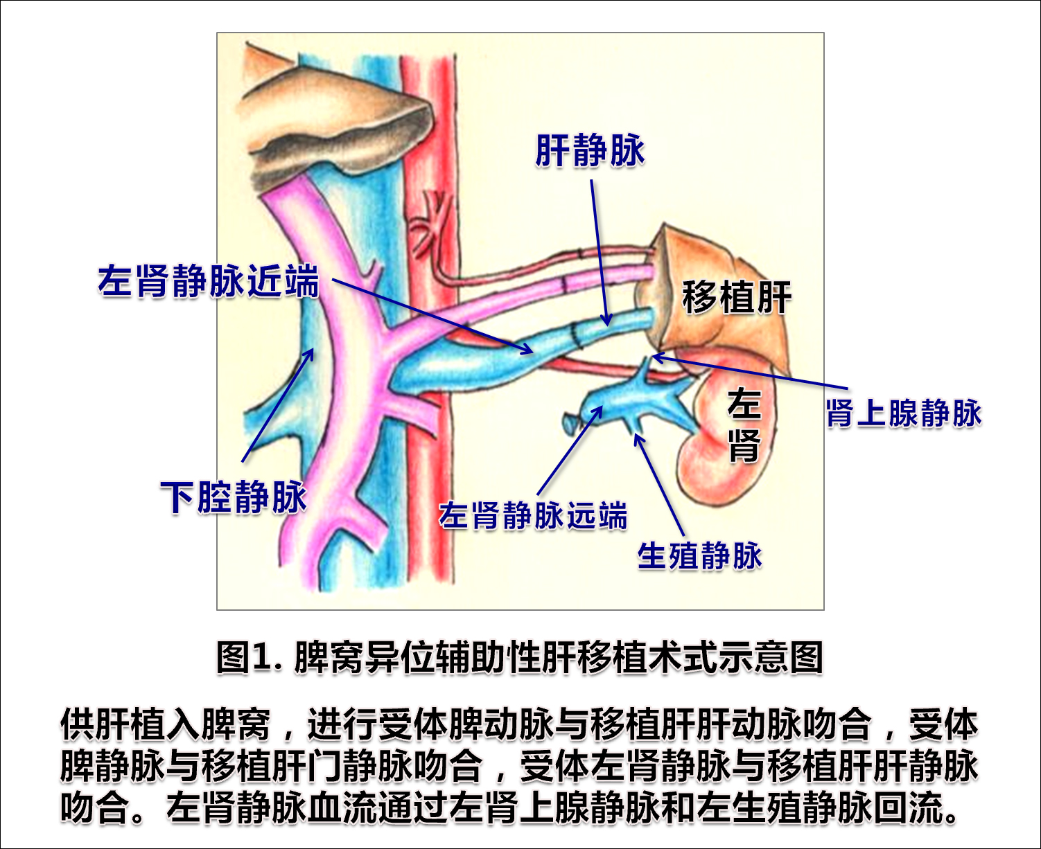 图片1-脾窝异位辅助性肝移植术式示意图.jpg